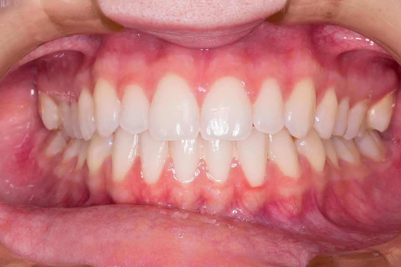 sonrisa gingival vitoria lakudent