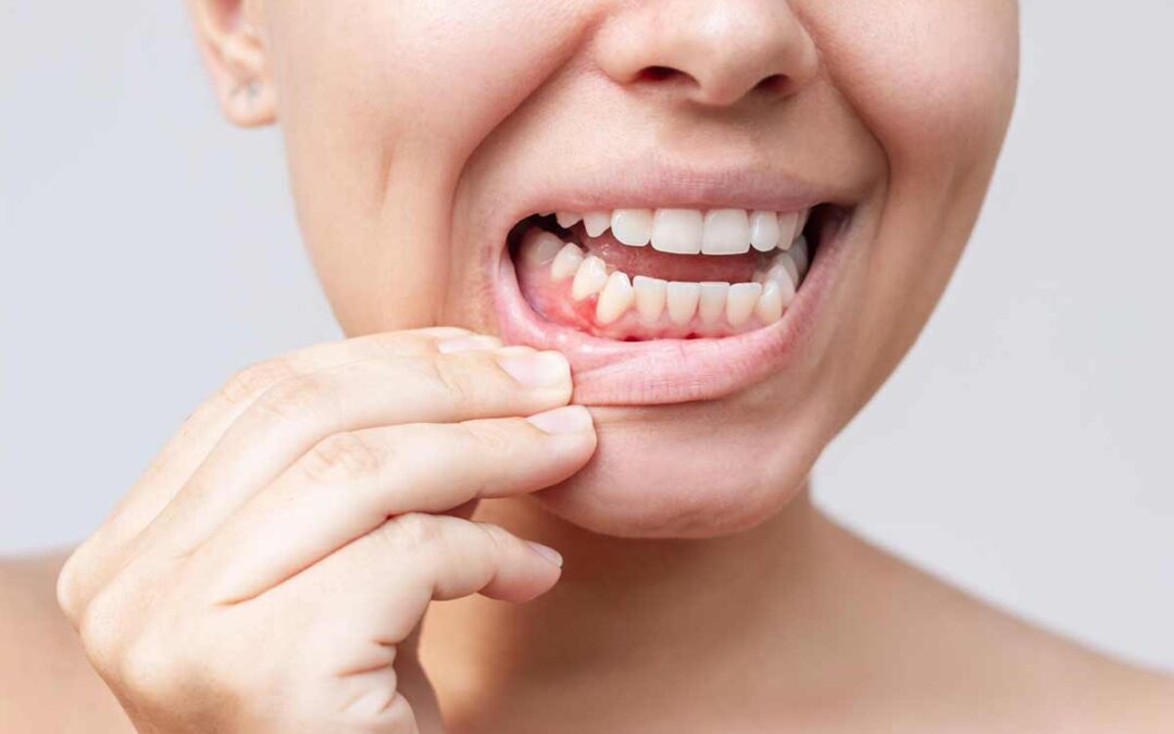 ¿Qué son los tratamientos para la gingivitis y la periodontitis?