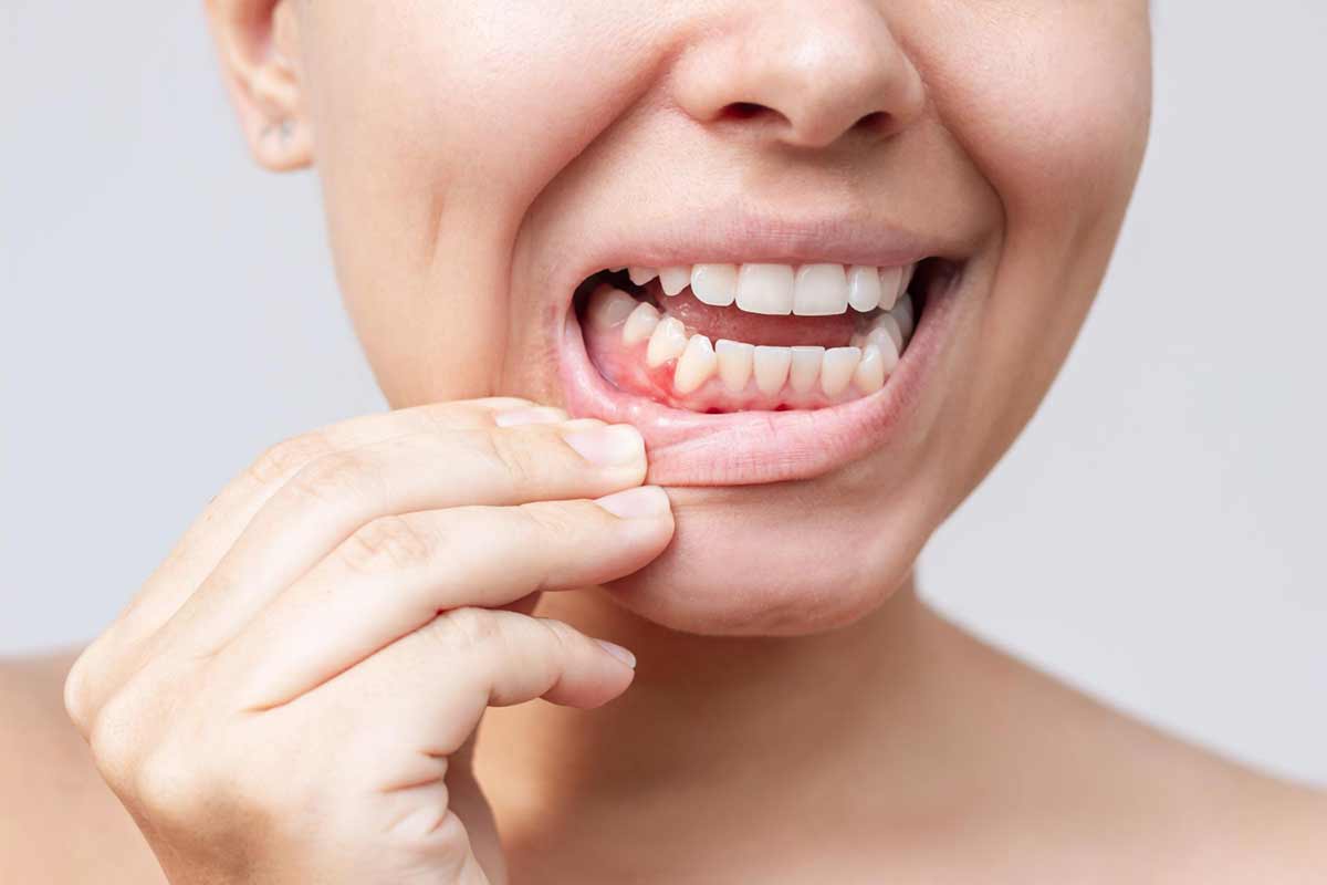 que-es-la-gingivitis-y-como-prevenirla