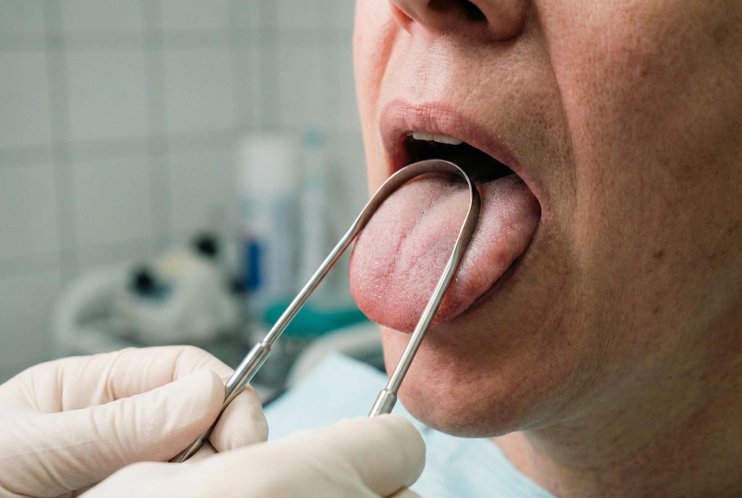 primer plano de una lengua siendo limpiada con limpiador lingual metálico.
